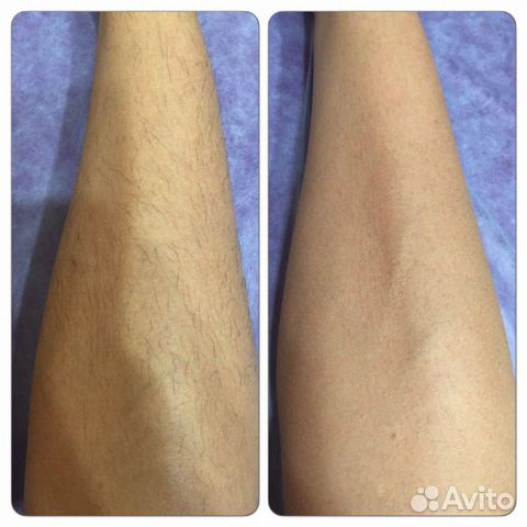 Депиляция шугаринг, воск Депиляция шугаринг, воск