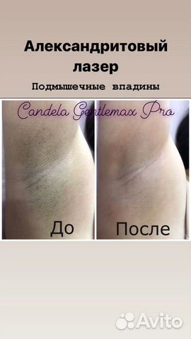 Лазерная эпиляция candela.Александритовый лазер Лазерная эпиляция candela.Александритовый лазер