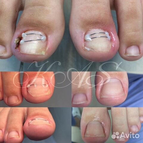 Вросший ноготь, медицинский педикюр, подолог