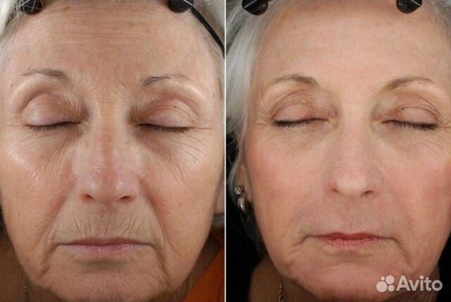 Услуги косметолога / Лазерная шлифовка лица в Санкт-Петербурге | Услуги ...